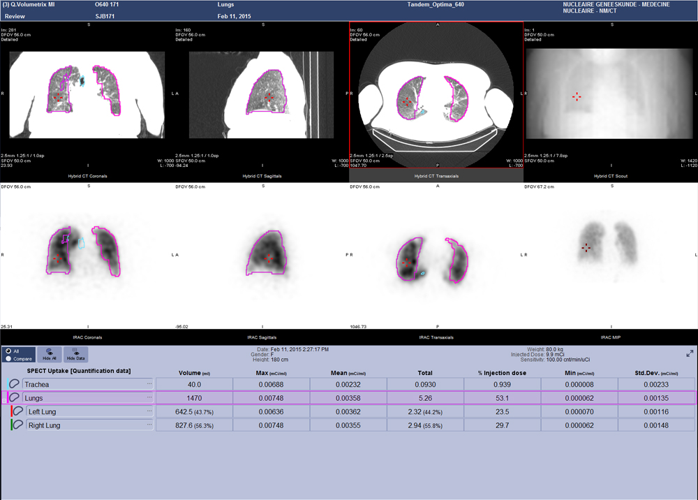 Volumetrix MI provides tools to easy segment organs and lesions providing quantitative informations 