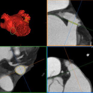 product-product-categories-interventional-x-ray-igs-for-ep-valveavecmultioblique.jpg