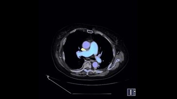 Post-treatment: Thrombosis Image (Effective-Z)
