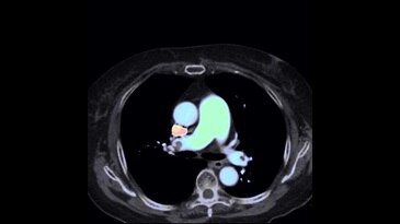 Pre-treatment: Thrombosis Image (Effective-Z)