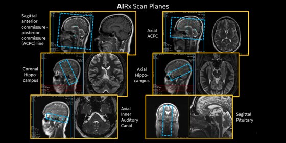 GE Healthcare’s AI-based, automated workflow tool for MRI