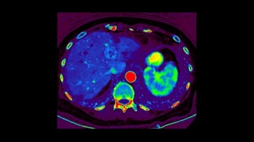 MD iodine (water) with color overlay