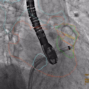egories-interventional-x-ray-igs-for-interventional-cardiology-guide-valve-assist-laac.jpg