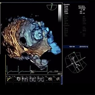 gories-interventional-x-ray-igs-for-interventional-cardiology-assess-valve-assist-laac.jpg