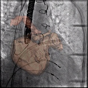 product-product-categories-interventional-x-ray-igs-for-ep-guide-ep-ablation.jpg