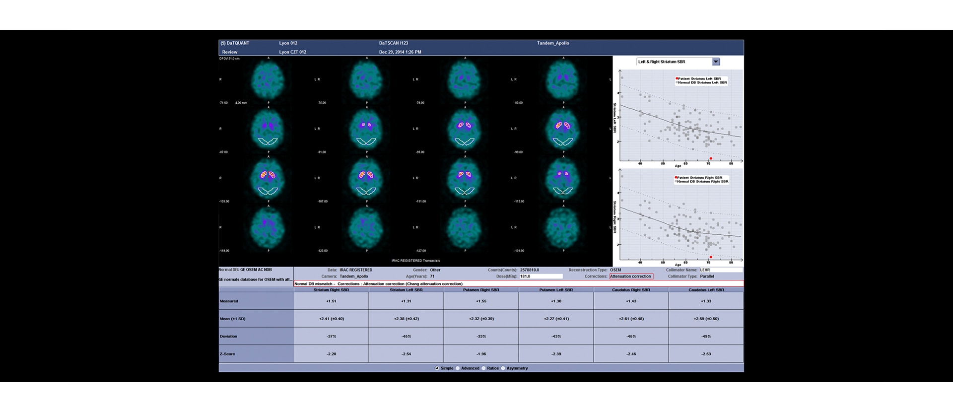 GEHC Xeleris 4 DR DaTQUANT Image 1 v1