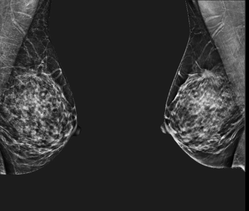 Randomized trial on tomosynthesis