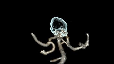 Angio image confirming vessel patency