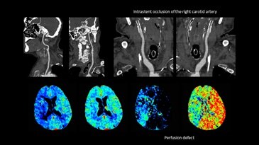 Head and neck CTA and neuro perfusion in one exam
