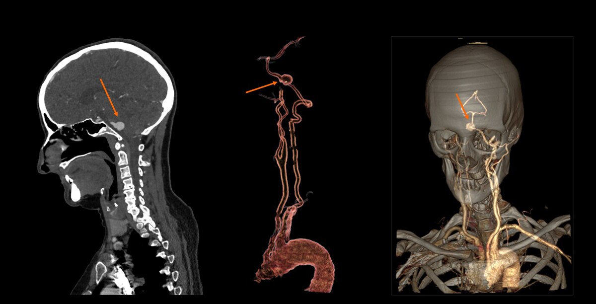 Carotids, assessment of aneurism at 1.8 mSv1