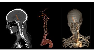 Carotids, assessment of aneurism at 1.8 mSv1