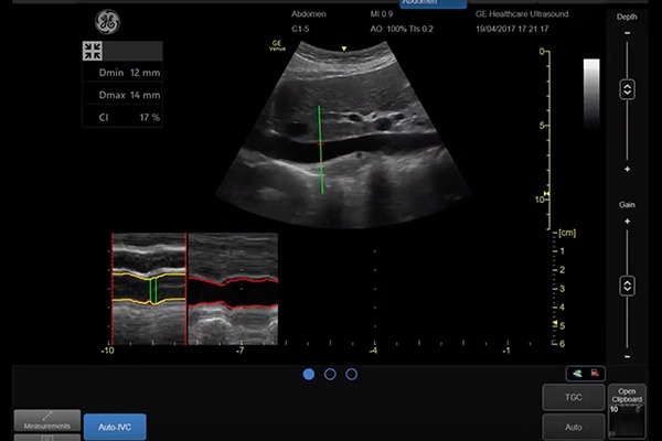 Venue Auto IVC Tool