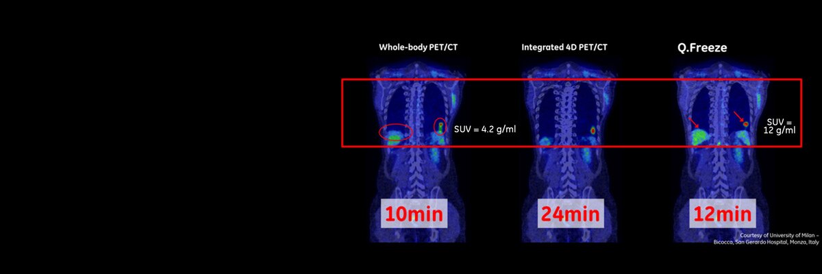 product-product-categories-pet-ct-clinical-cases-qfreeze-gehc-pet-ct-qfreeze_spotlight.jpg
