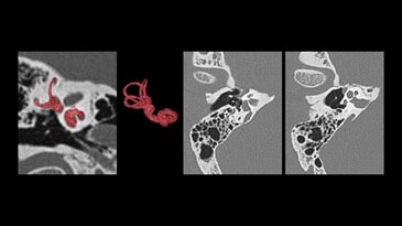 Excellent spatial resolution for inner ear