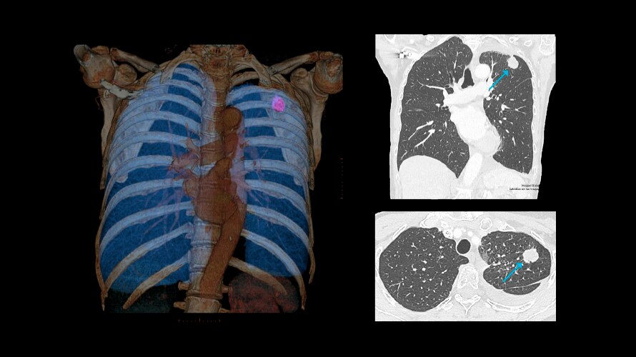 Low-dose chest CT for lung cancer follow-up 