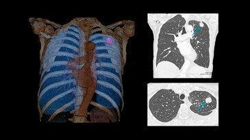 Low-dose chest CT for lung cancer follow-up