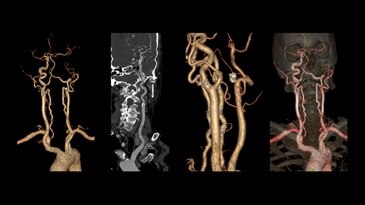 Head and neck CTA: excellent IQ for left carotid occlusion