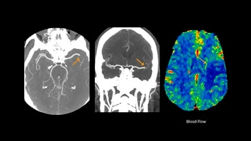 Cerebral CTA and perfusion study for stroke evaluation