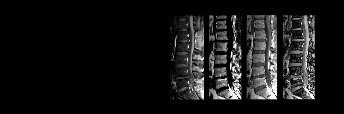 product-product-categories-magnetic-resonance-imaging-spine-imaging-ideal-spine_ideal.jpg
