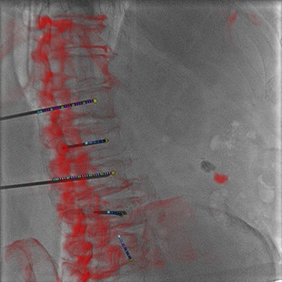 ct-categories-interventional-x-ray-igs-for-hybrid-or-discovery igs 730-needle-assist-2.jpg