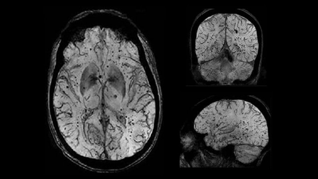 product-product-categories-magnetic-resonance-imaging-mr signa-ture applications-neuro-swan.png