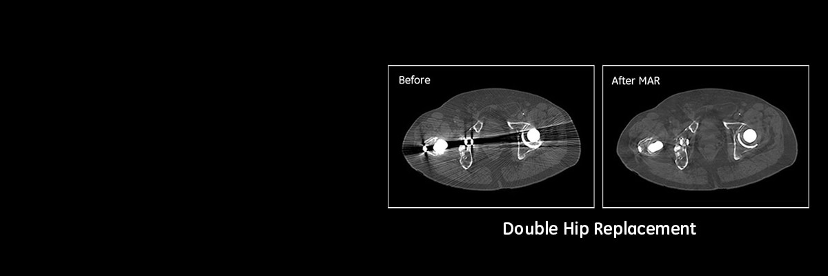 categories-computed-tomography-metal-artifact-reduction-ct-mar-coronal-hip-spotlight-3.jpg
