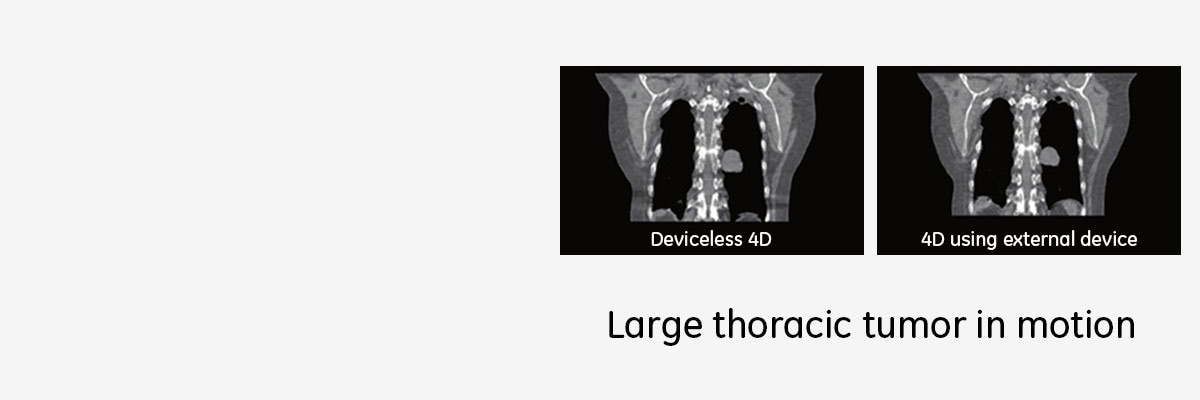 smart deviceless 4d-gehc--smart-deviceless-4d_large-thoracic-tumor-in-motion_spotlight.jpg