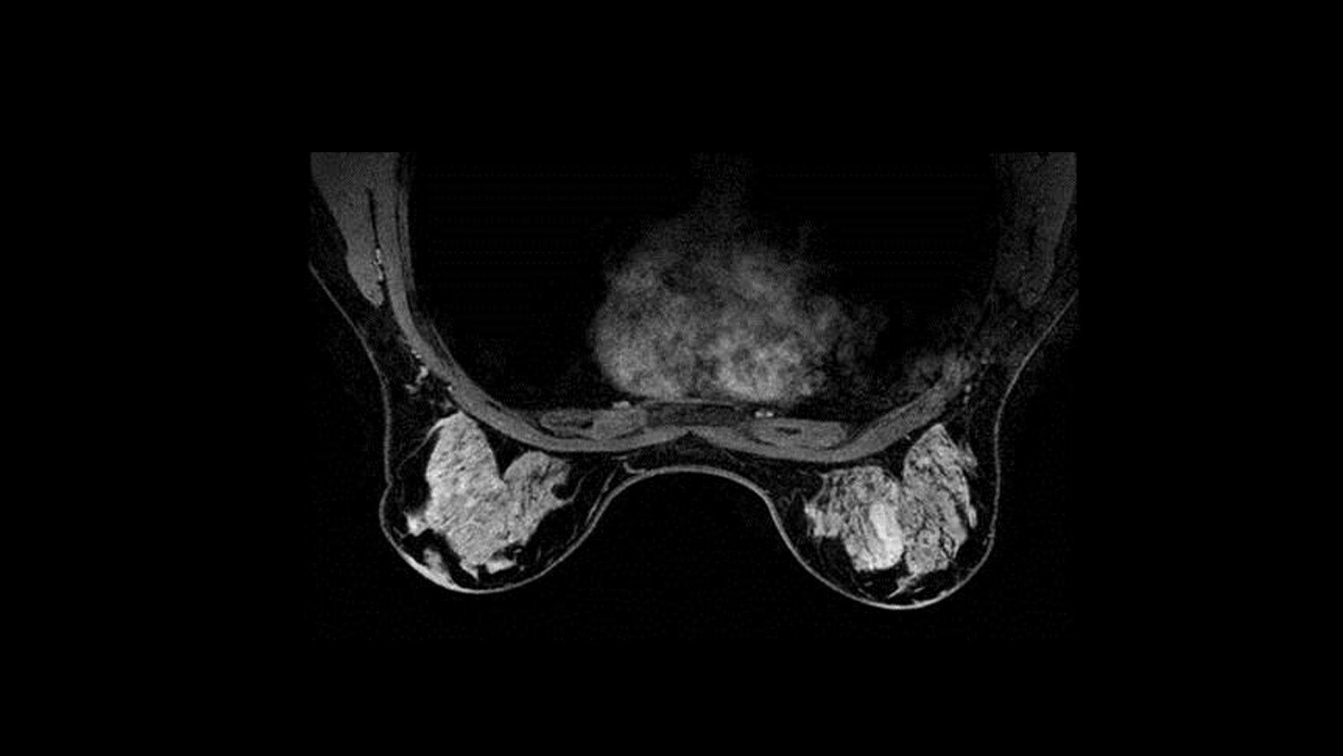 VIBRANT breast clinical.