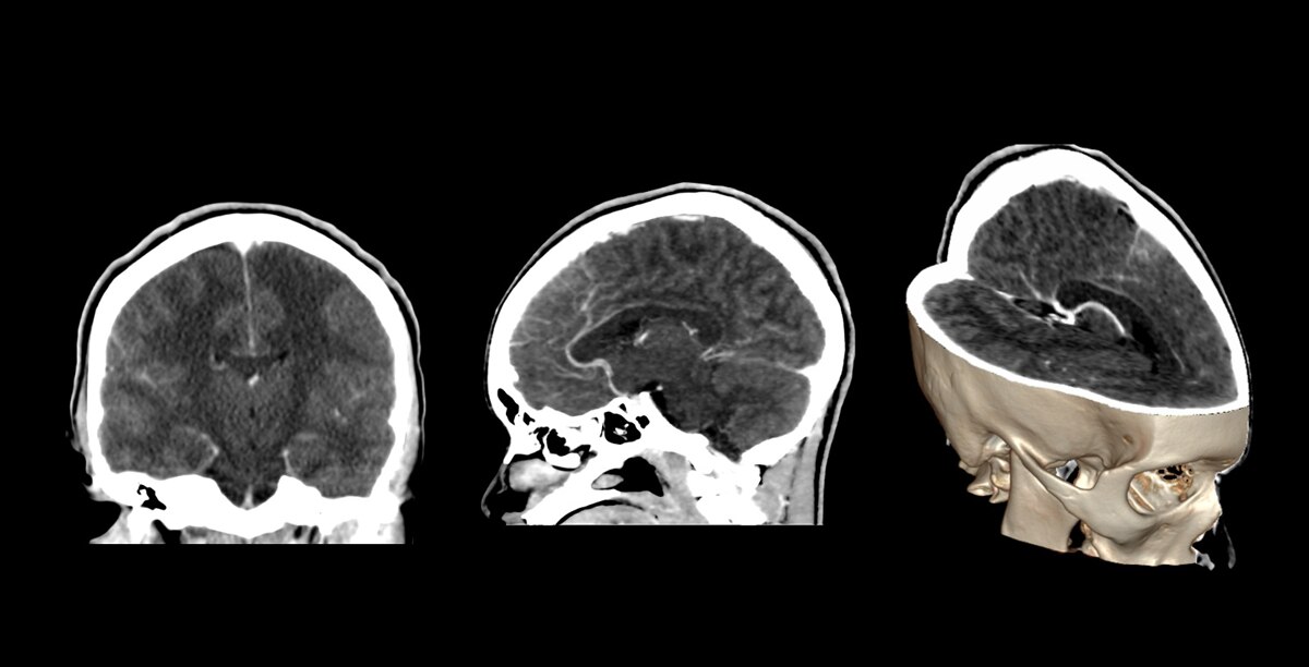 Brain with contrast at 1 mSv1