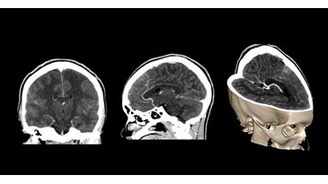 Brain with contrast at 1 mSv1
