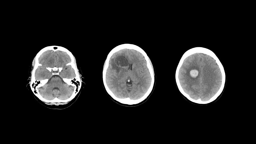 Non-contrast brain images showing good tissue discriminationat 1.1 mSv 