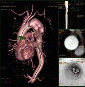 advanced visualization mr vesselIQ xpress.