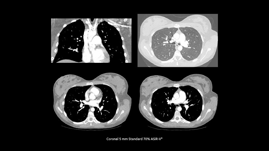 Ultra-low-dose CT pulmonary angiography on a 33-week pregnant woman