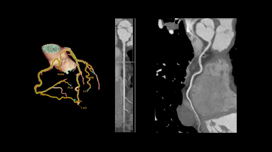 Ultra-low-dose thorax exam for lung disease follow-up 