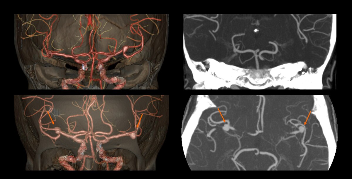 Circle of Willis