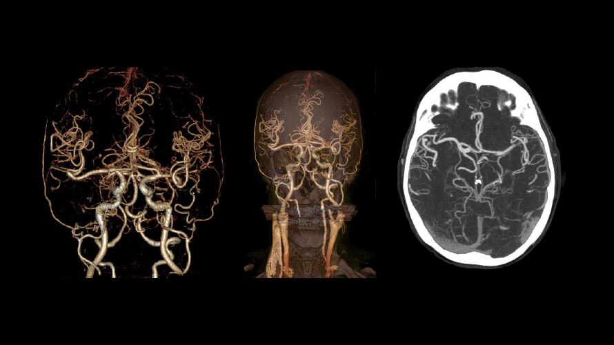 Low-dose and high-quality CT for Circle of Willis
