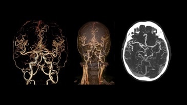 Low-dose and high-quality CT for Circle of Willis