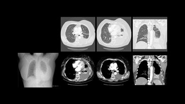 High-resolution chest CT, 32 BMI, showing pleural effusion