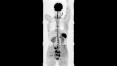 eDWI body imaging application clinical image
