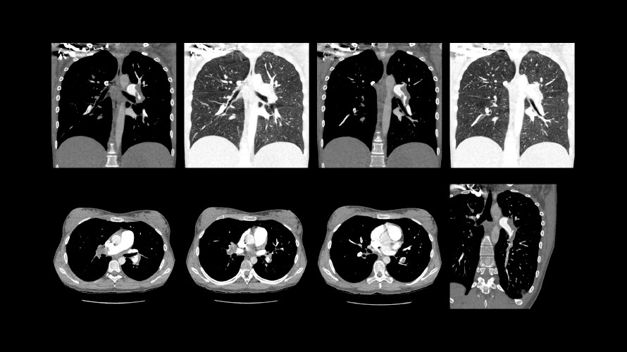 Low-dose CT for lung embolism 