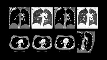 Low-dose CT for lung embolism