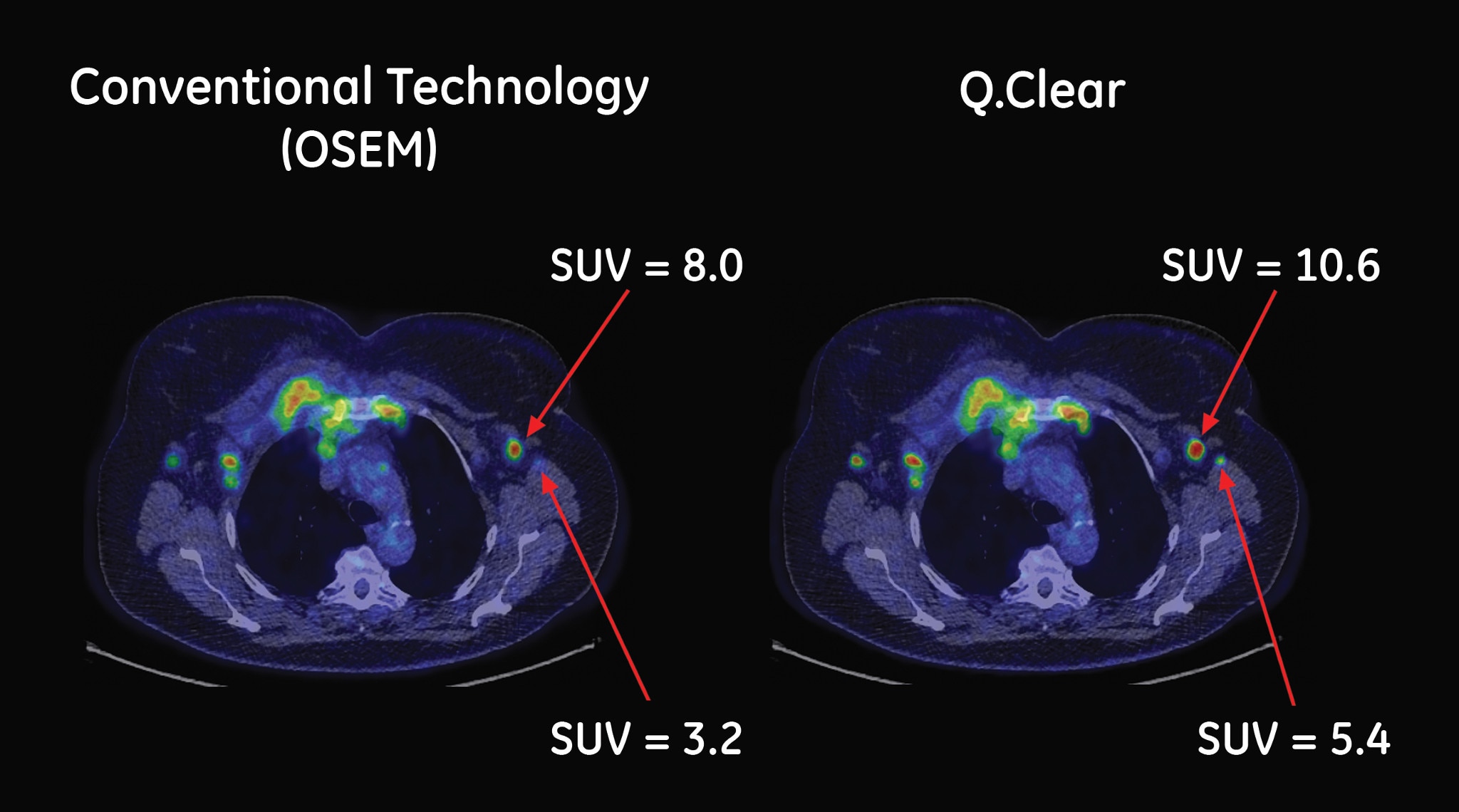Conventional Technology (Standard OSEM) vs Q.Clear